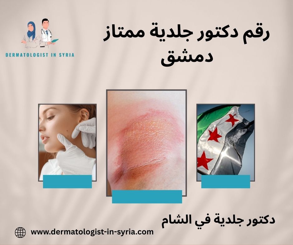 افضل دكتور جلدية في دمشق