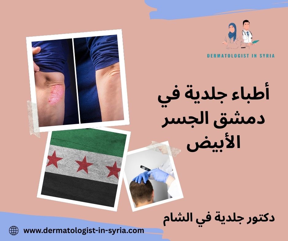 دكتور جلدية دمشق المزة