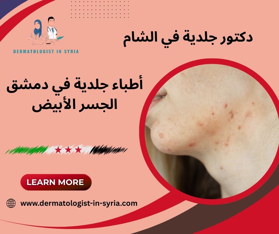 أطباء جلدية في دمشق الجسر الأبيض