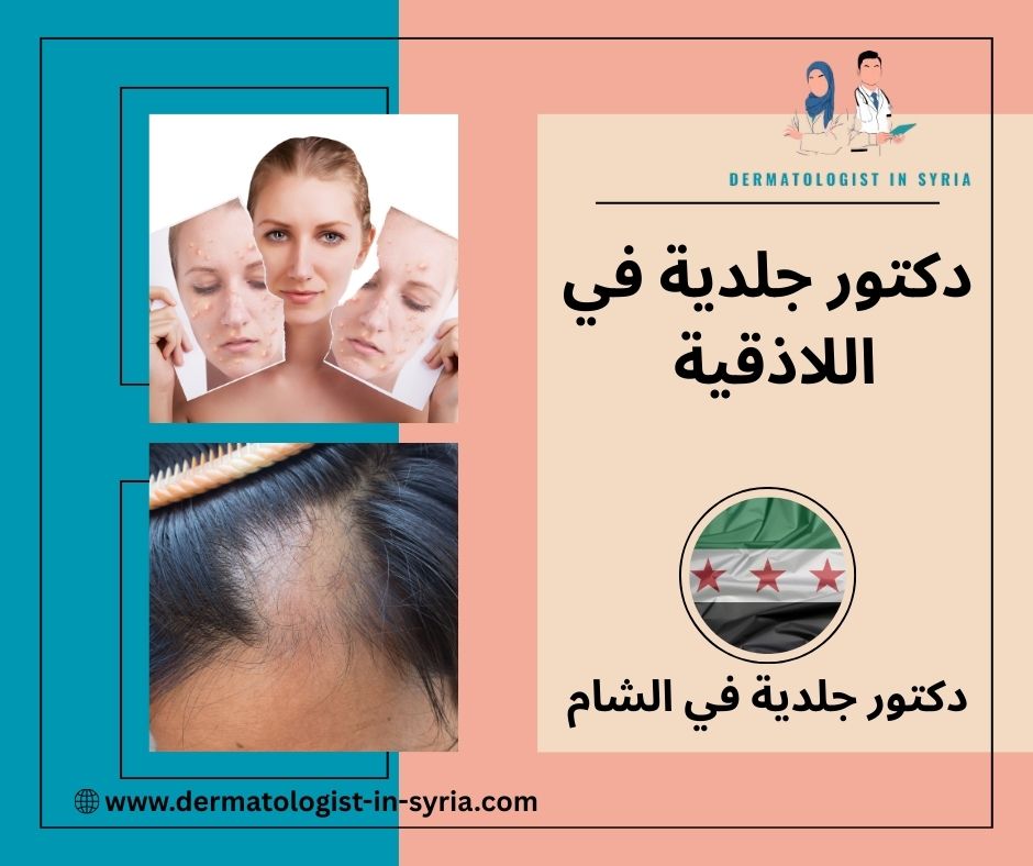 دكتور جلدية في اللاذقية