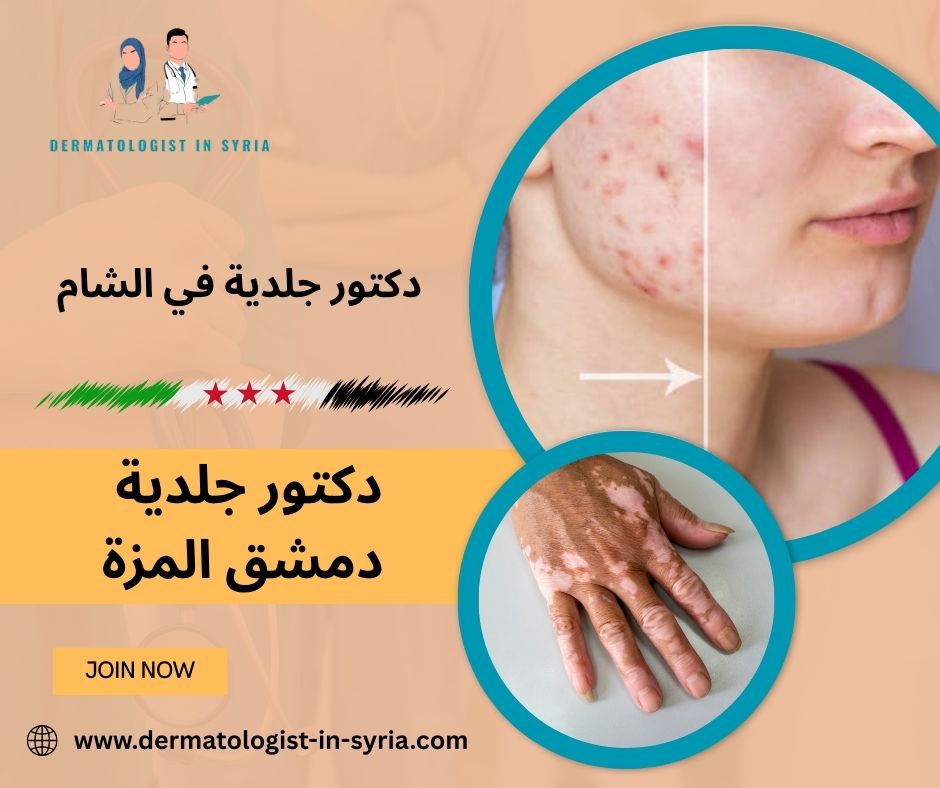 دكتور جلدية دمشق المزة