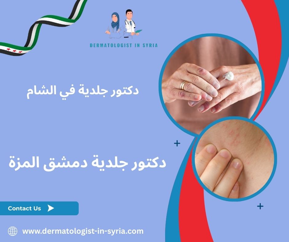 دكتور جلدية دمشق المزة