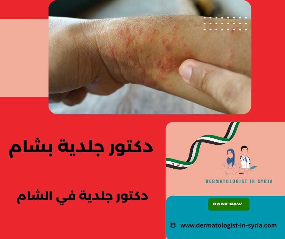 دكتور جلدية شاطر بشام