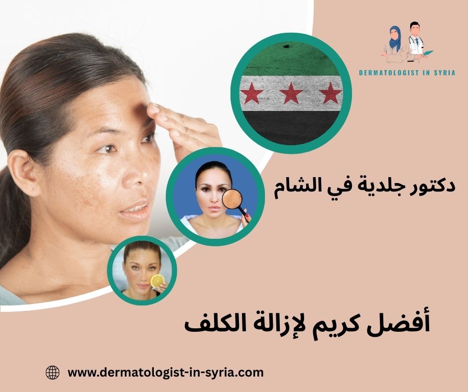 أفضل كريم لإزالة الكلف أفضل كريم لإزالة الكلف