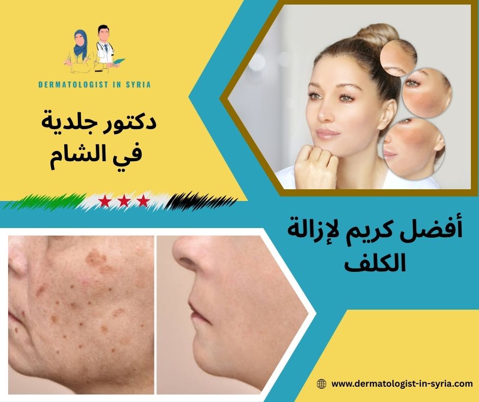 أفضل كريم لإزالة الكلف