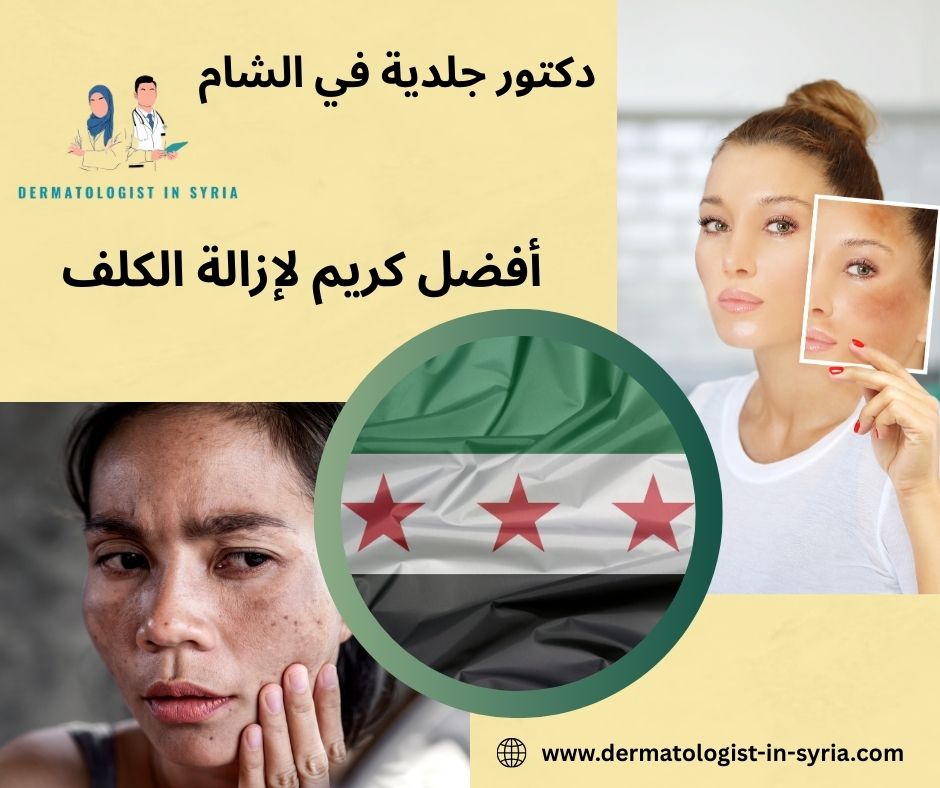 افضل كريم لازالة الكلف نهائيا افضل كريم لازالة الكلف نهائيا