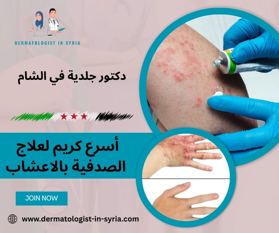 أسرع كريم لعلاج الصدفية بالاعشاب