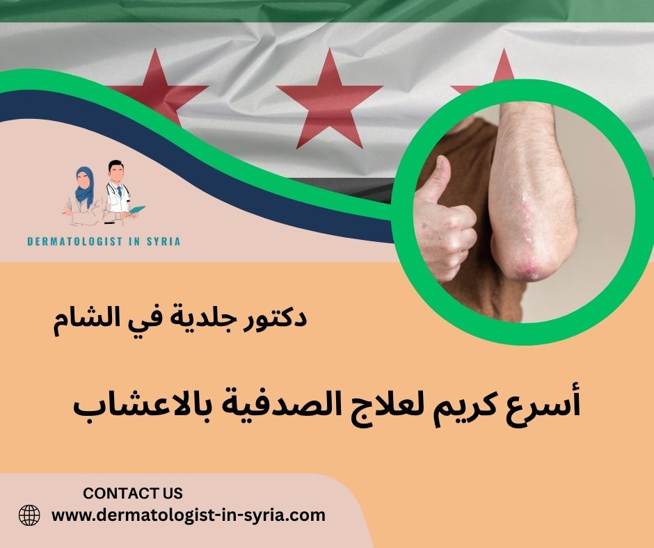 أسرع كريم لعلاج الصدفية الشعر أسرع كريم لعلاج الصدفية الشعر