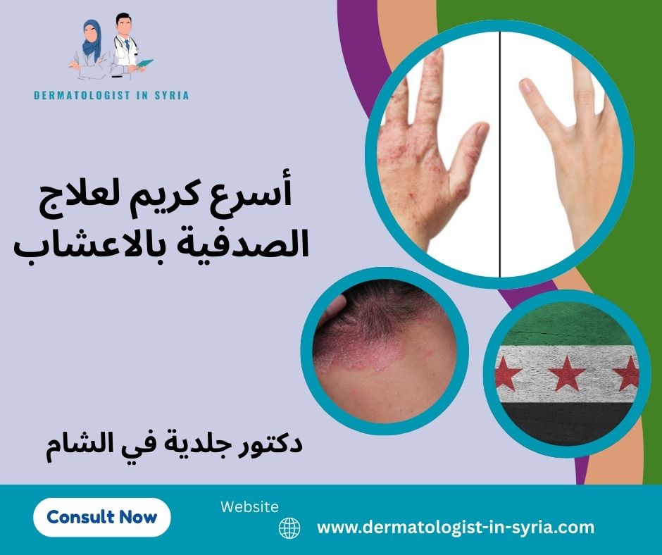 علاج الصدفية بشكل نهائي علاج الصدفية بشكل نهائي