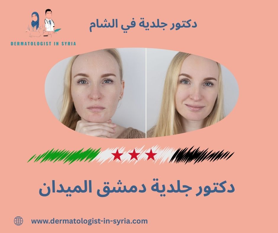 دكتور جلدية دمشق الميدان