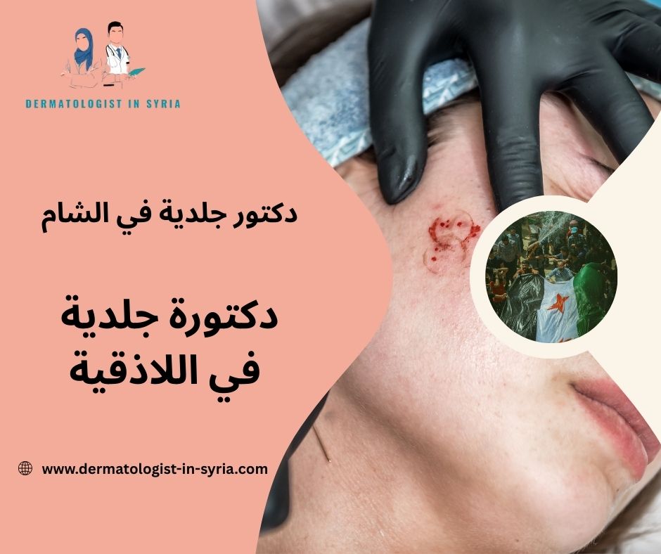 افضل دكتور جلدية في دمشق افضل دكتور جلدية في دمشق