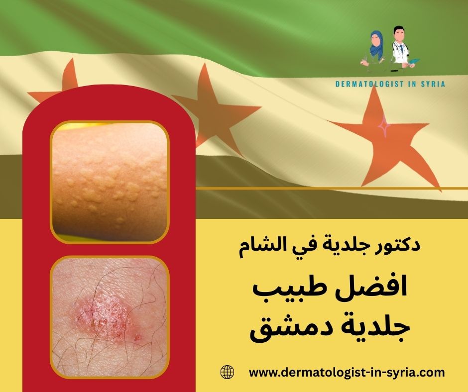 افضل طبيب جلدية دمشق افضل طبيب جلدية دمشق