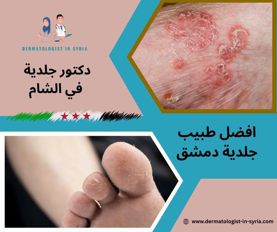 من هو افضل طبيب جلدية دمشق؟ من هو افضل طبيب جلدية دمشق؟