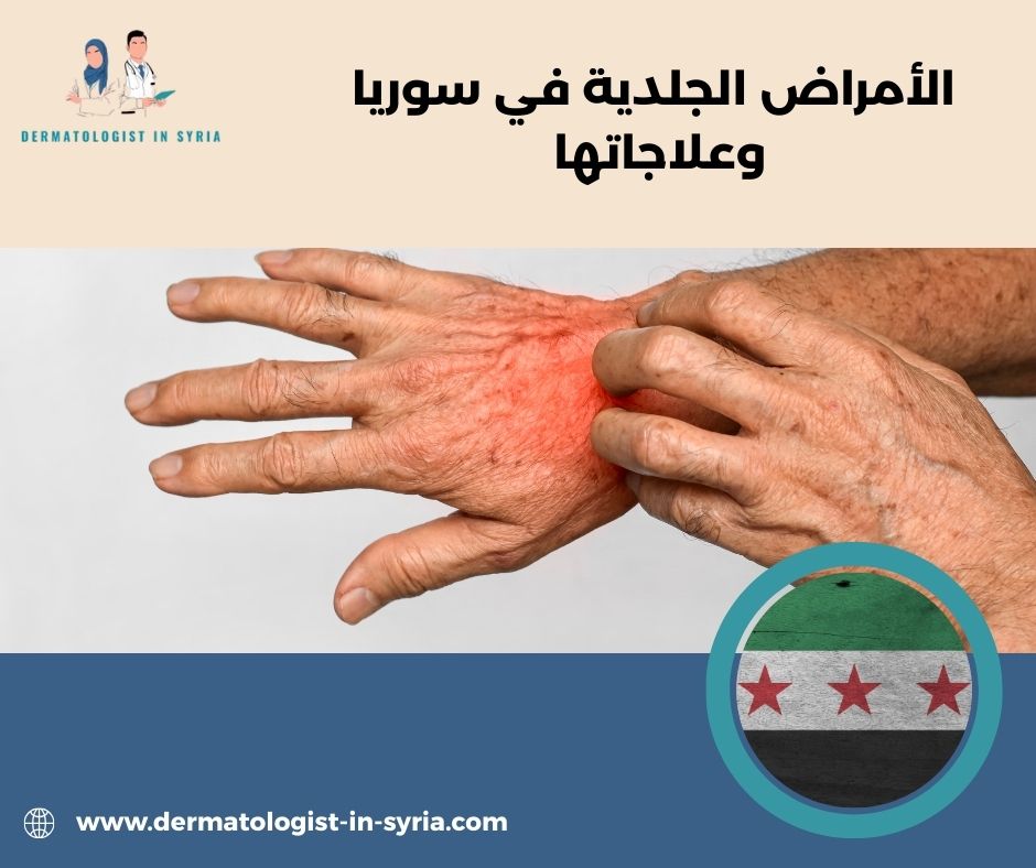 أهم الأمراض الجلدية في سوريا: تشخيص مختصر + علاج عملي