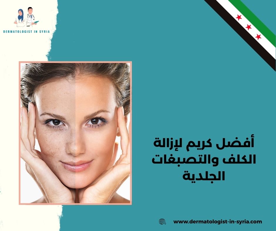 أفضل كريم لإزالة الكلف والتصبغات الجلدية