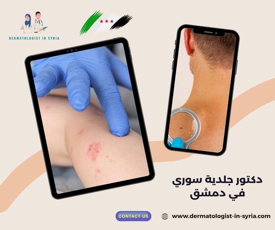 دكتور جلدية سوري في دمشق