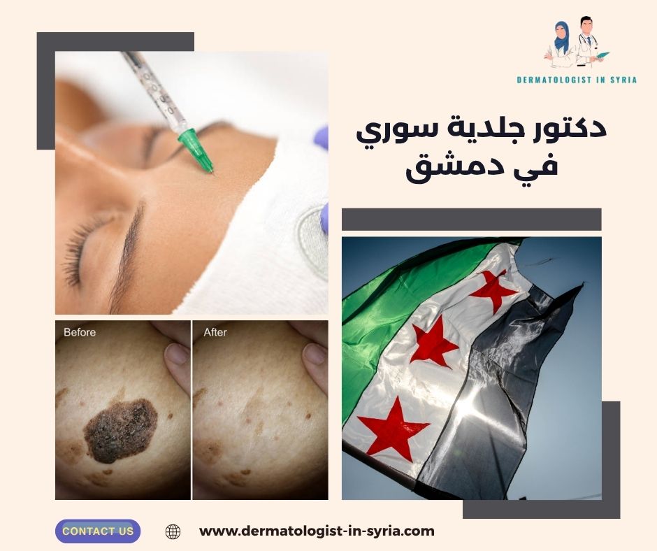 دكتور جلدية سوري في دمشق