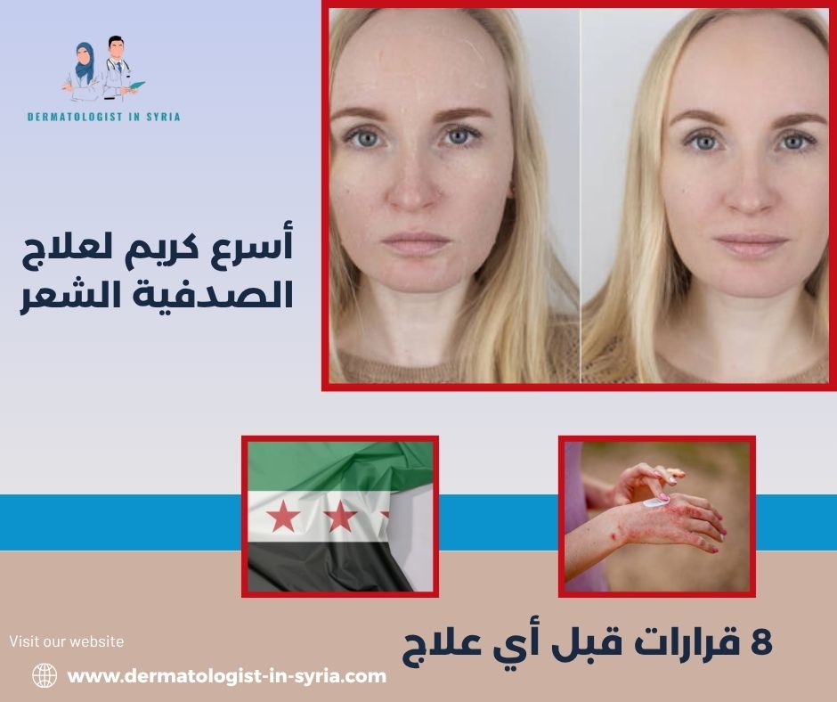 أسرع كريم لعلاج الصدفية الشعر