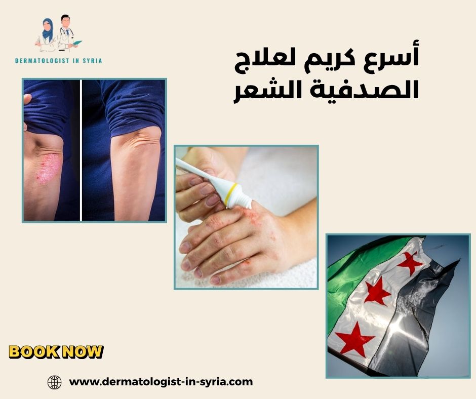 أسرع كريم لعلاج الصدفية الشعر