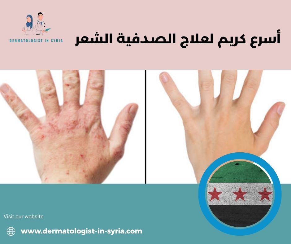 أسرع كريم لعلاج الصدفية الشعر