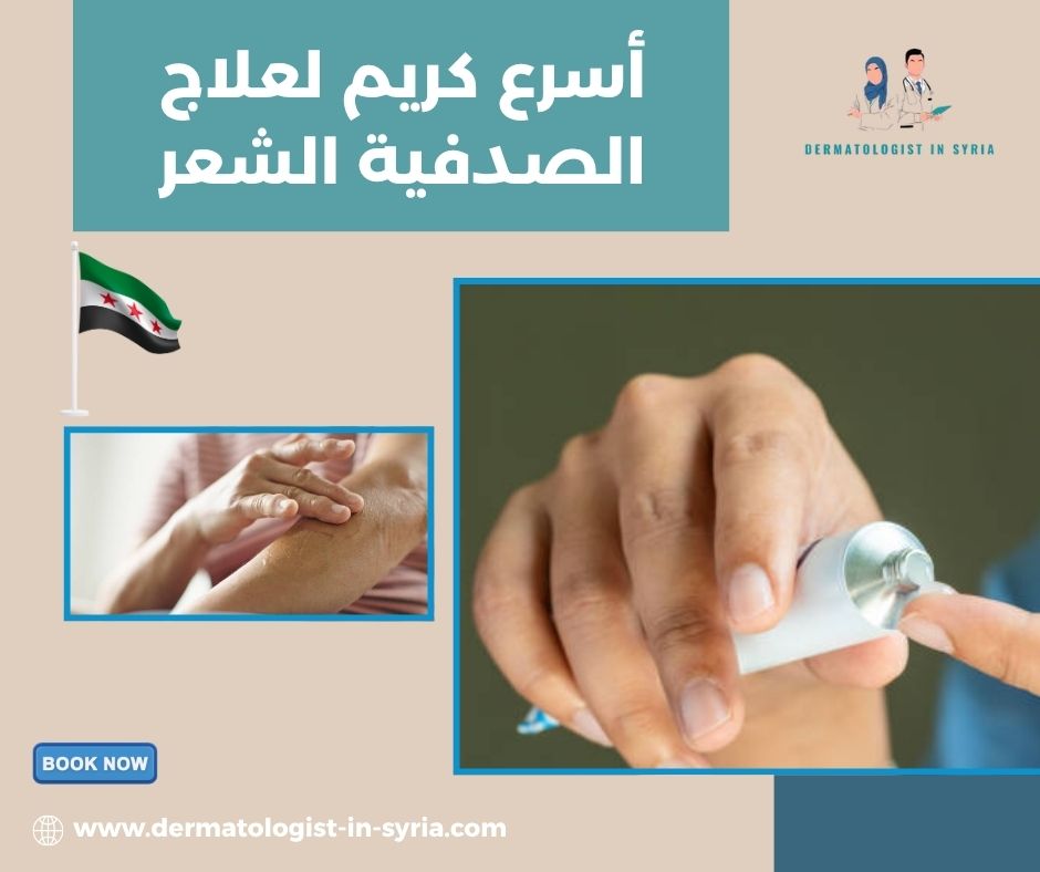 أسرع كريم لعلاج الصدفية الشعر