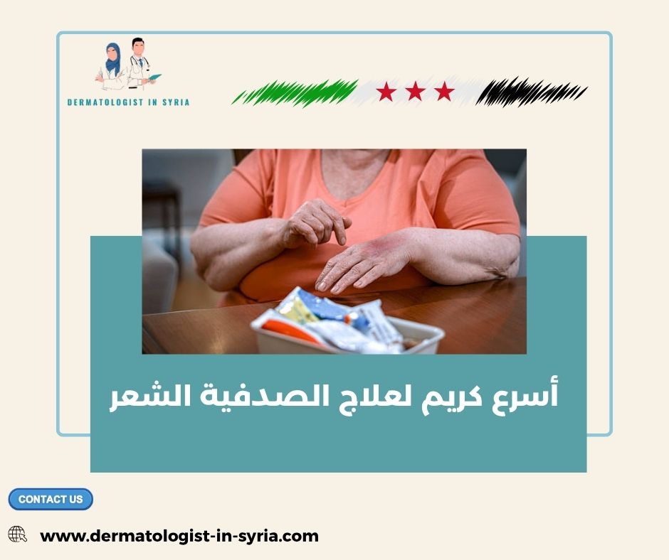 أسرع كريم لعلاج الصدفية الشعر