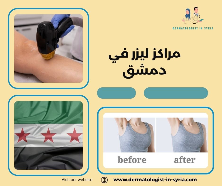 مراكز ليزر في دمشق مراكز ليزر في دمشق
